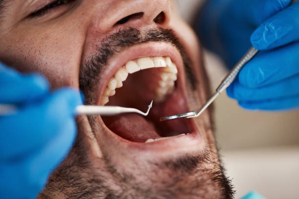 Best Emergency Dentist for Lost Fillings or Crowns in Bon Secour, AL